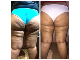 Celulitis - Amarna Médica Estética