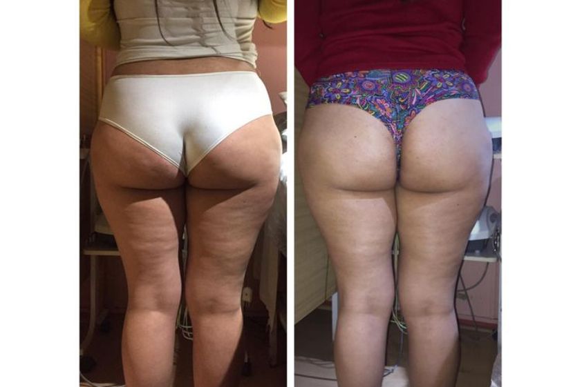 Tratamiento celulitis antes y después - 663920