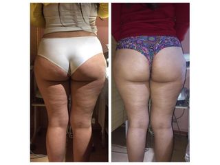 Celulitis - Amarna Médica Estética
