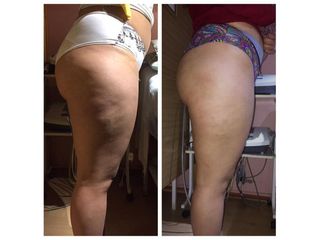 Celulitis - Amarna Médica Estética