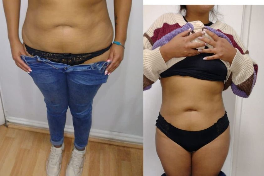 Criolipólisis antes y después - 842547