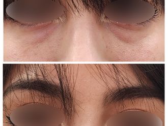 Tratamiento de ojeras antes y después - 867986