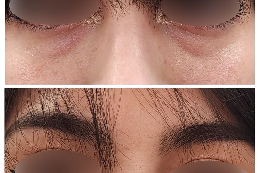 Tratamiento de ojeras antes y después - 867986