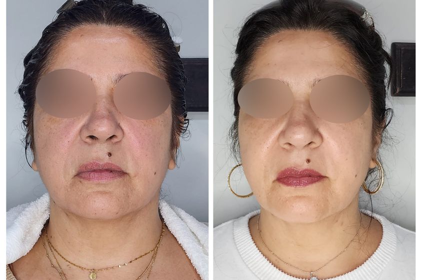 Hilos tensores antes y después - 867987