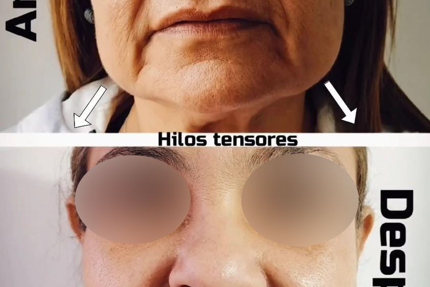 Hilos tensores antes y después - 867989