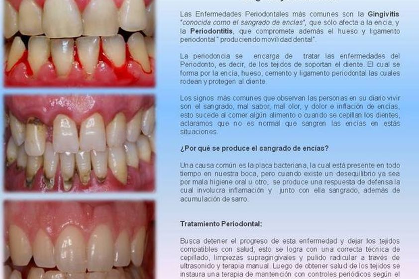 Periodoncia antes y después - 572594