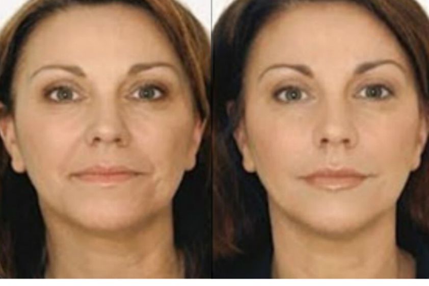 Carboxiterapia antes y después - 500106