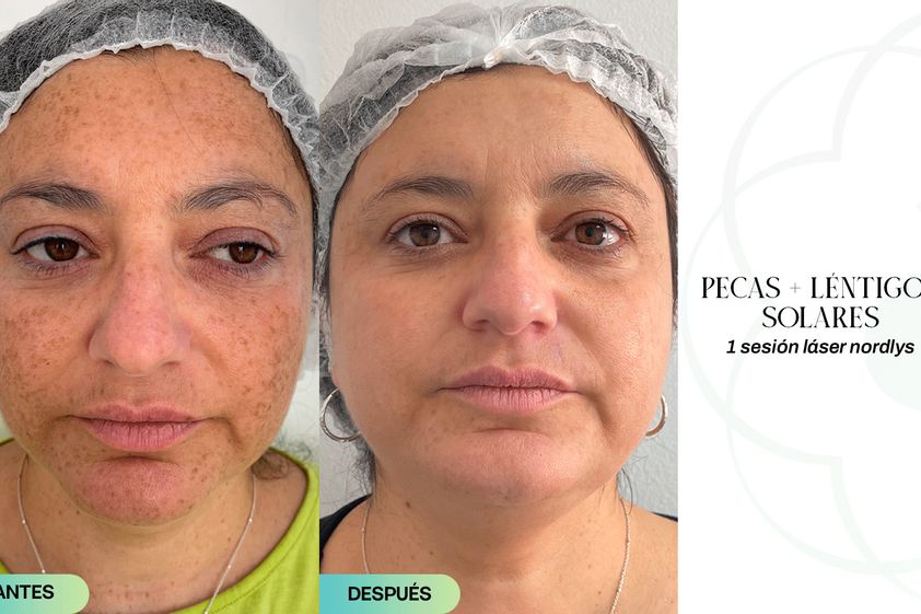 Luz pulsada antes y después - 853623