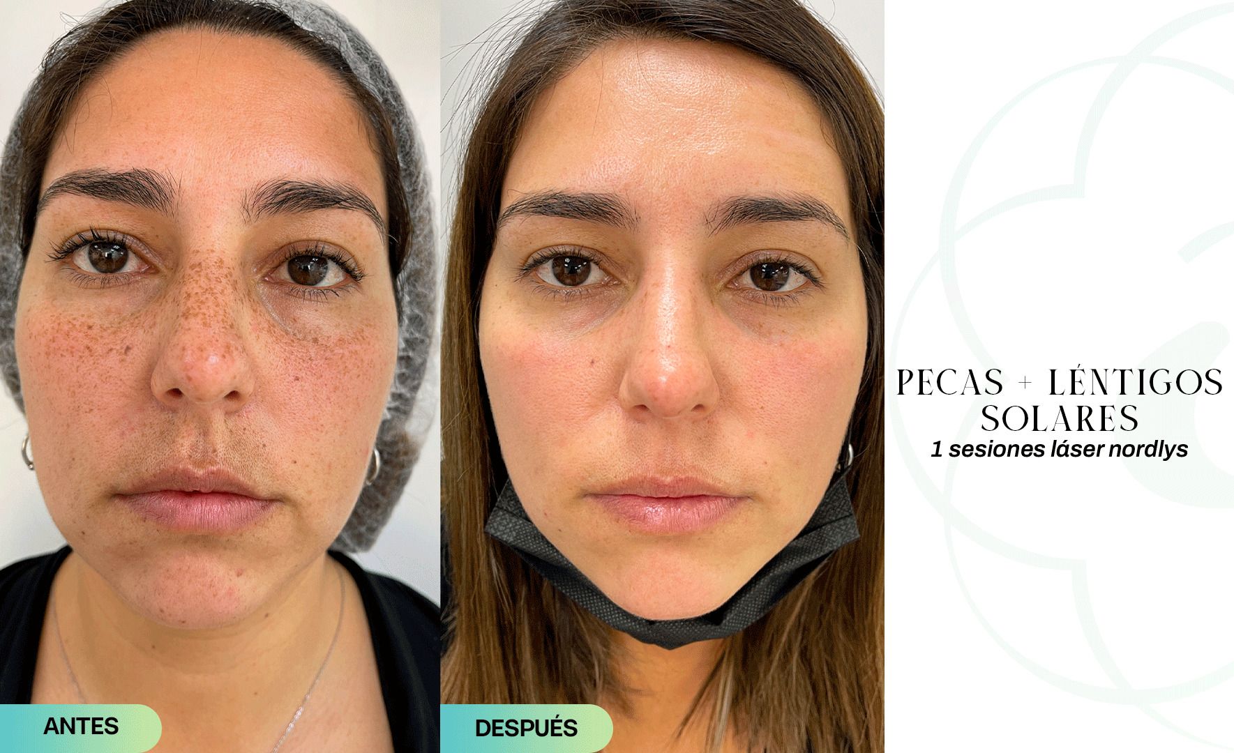 Luz pulsada Antes y después - Clinicasesteticas.cl