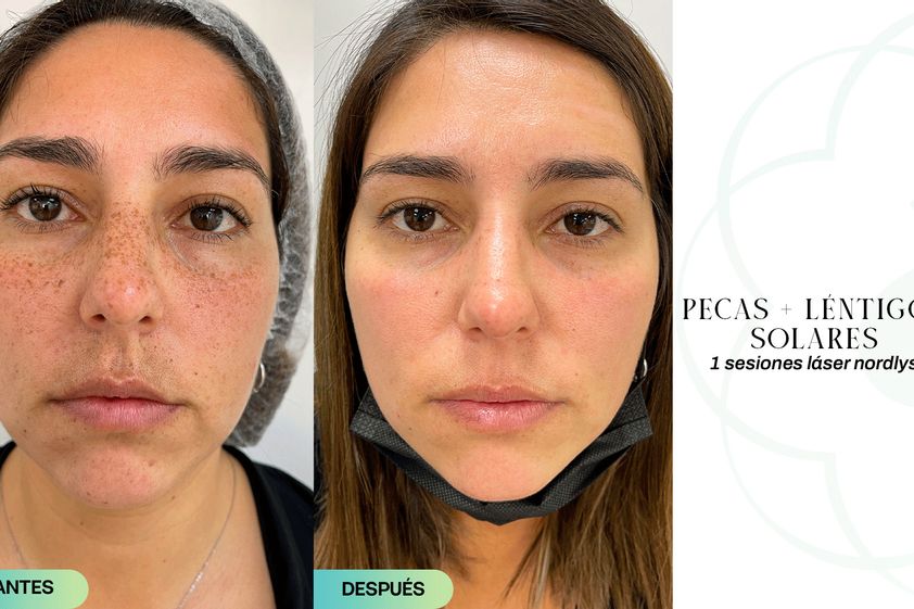 Luz pulsada antes y después - 853624