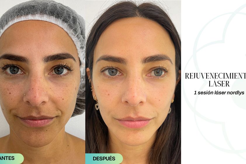 Luz pulsada antes y después - 853625