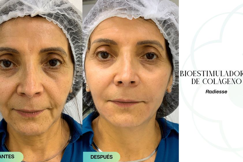Rejuvenecimiento facial antes y después - 853628
