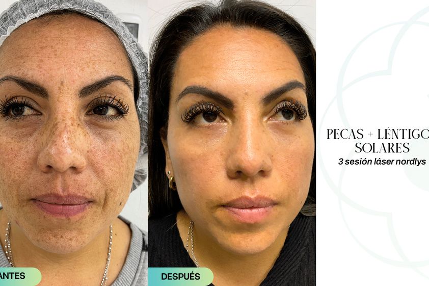 Luz pulsada antes y después - 853631