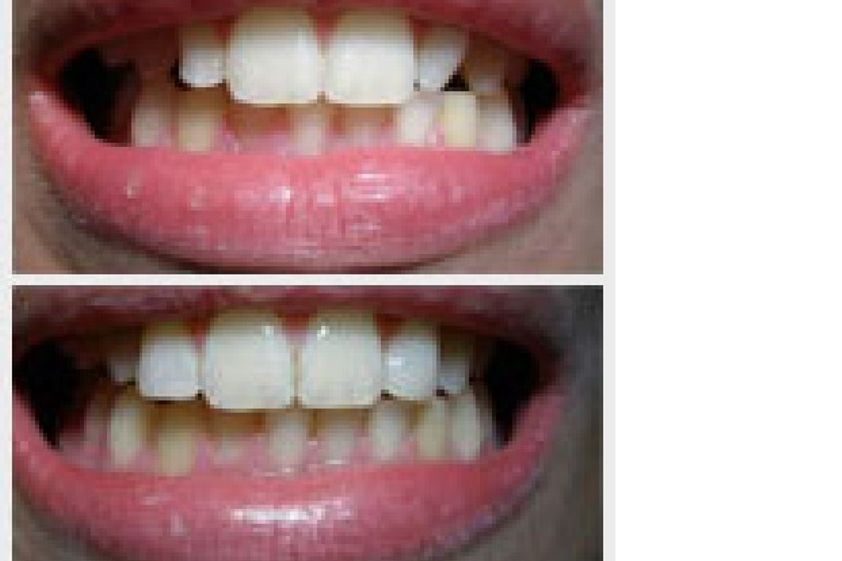 Carillas dentales antes y después - 575166