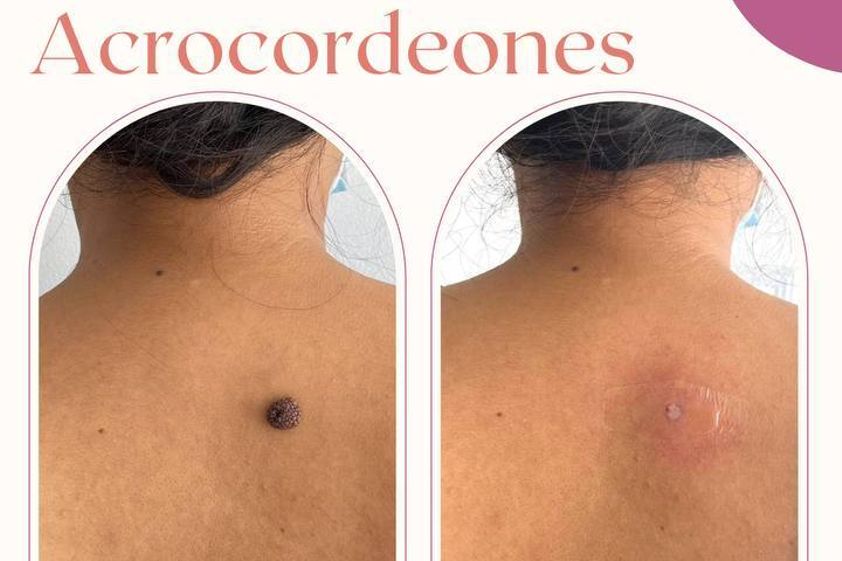 Verrugas antes y después - 821379