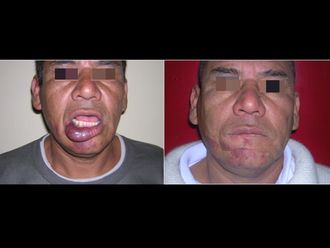 Psoriasis - 584547