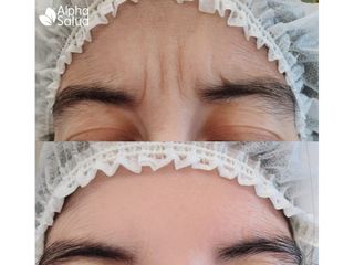 Botox - Alpha Salud