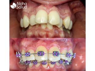 Ortodoncia - Alpha Salud