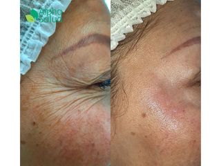 Botox - Alpha Salud