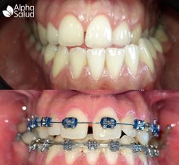 Brackets - Alpha Salud