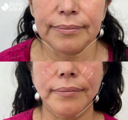 Armonización facial - Alpha Salud