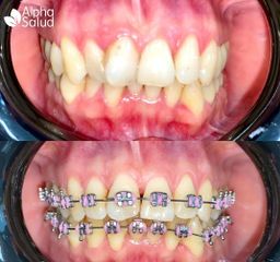 Brackets - Alpha Salud