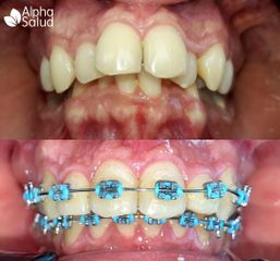 Brackets - Alpha Salud