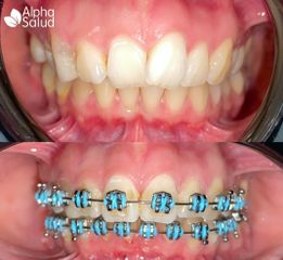 Brackets - Alpha Salud