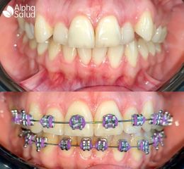 Brackets - Alpha Salud