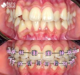 Brackets - Alpha Salud