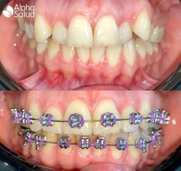 Brackets - Alpha Salud