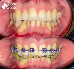 Brackets - Alpha Salud