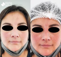 Peeling - Alpha Salud