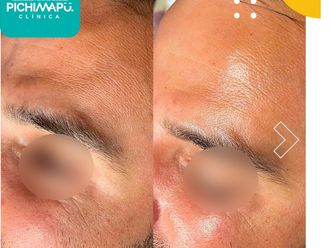 Rejuvenecimiento facial antes y después - 866504