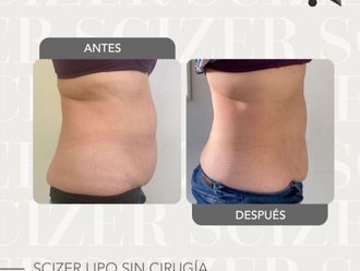 Lipoláser antes y después - 834838