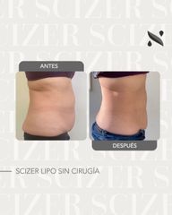 Scizer - Lipo sin Cirugia -Novavita Ltda