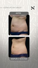 Scizer - Lipo sin cirugia