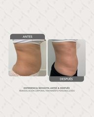 Scizer - Lipo Sin Cirugia - Novavita Ltda