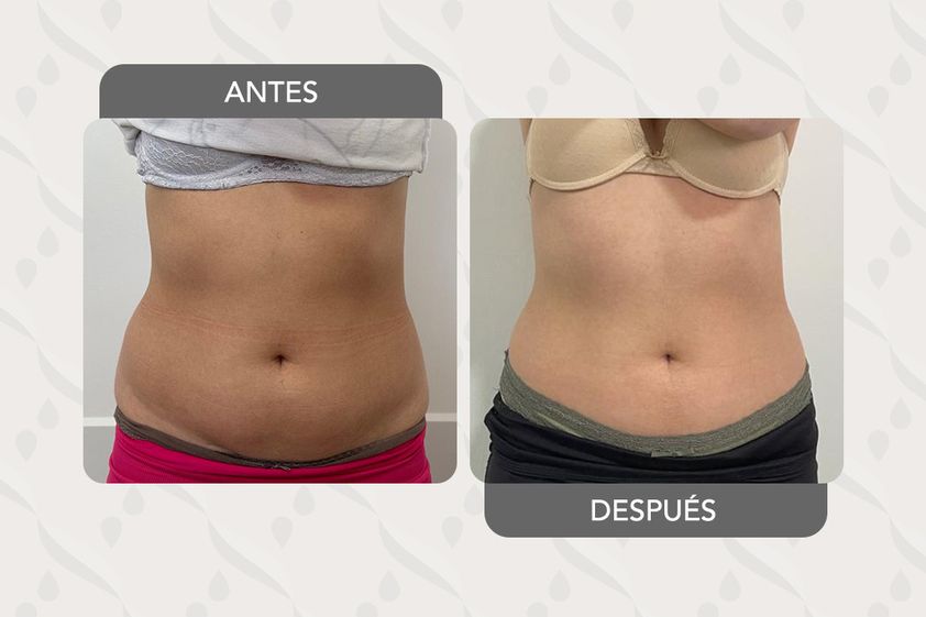 Lipoláser antes y después - 872557