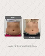 Scizer - Lipo Sin Cirugia -Novavita Ltda