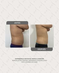 Scizer - Lipo Sin Cirugia - Novavita Ltda