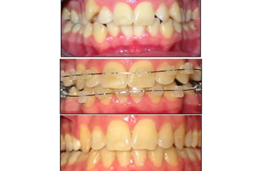 Brackets antes y después - 500453
