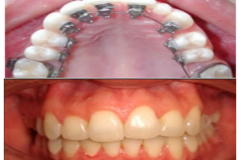 Ortodoncia antes y después - 500462