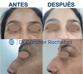 Eliminación de ojeras - Dr. Gunther Rochefort