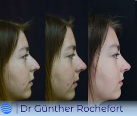 Rinomodelación - Dr. Gunther Rochefort