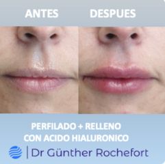 Aumento de labios - Dr. Gunther Rochefort