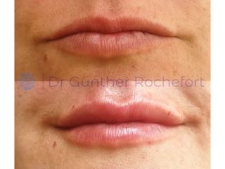 Aumento de labios - Dr. Gunther Rochefort