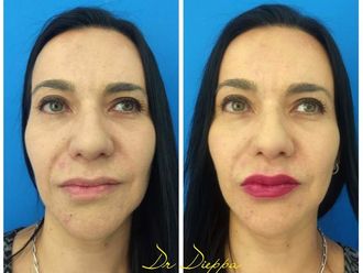 Aumento de labios - 637298