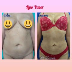Lipo vaser