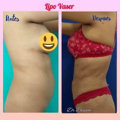 Lipo vaser
